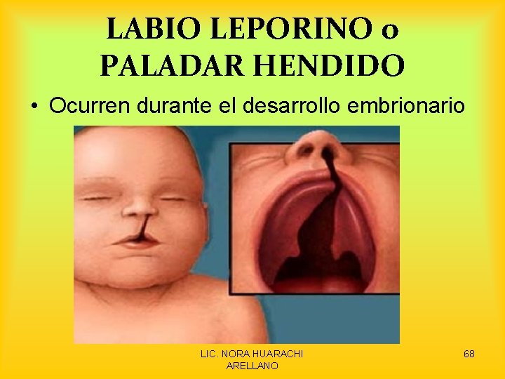 LABIO LEPORINO o PALADAR HENDIDO • Ocurren durante el desarrollo embrionario LIC. NORA HUARACHI