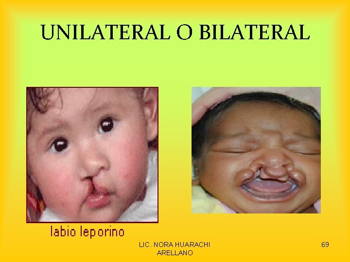 UNILATERAL O BILATERAL LIC. NORA HUARACHI ARELLANO 69 