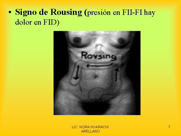  • Signo de Rousing (presión en FII-FI hay dolor en FID) LIC. NORA