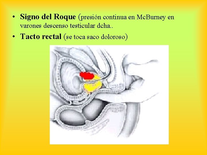  • Signo del Roque (presión continua en Mc. Burney en varones descenso testicular