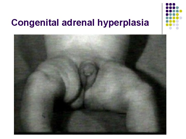 Congenital adrenal hyperplasia 