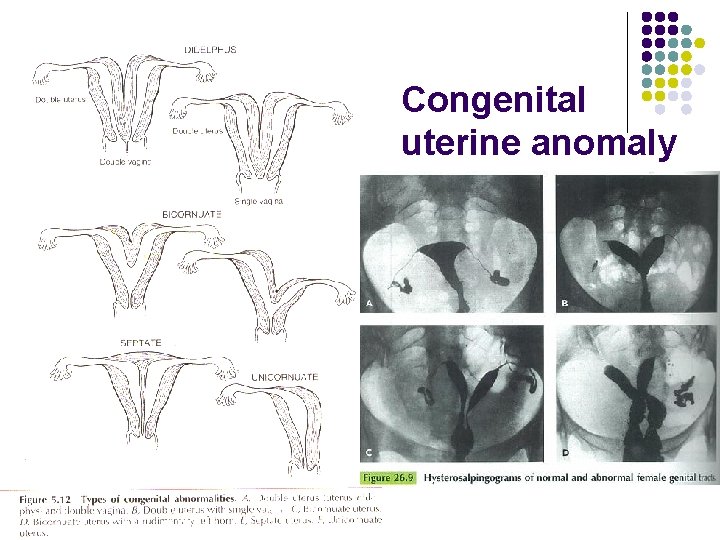 Congenital uterine anomaly 
