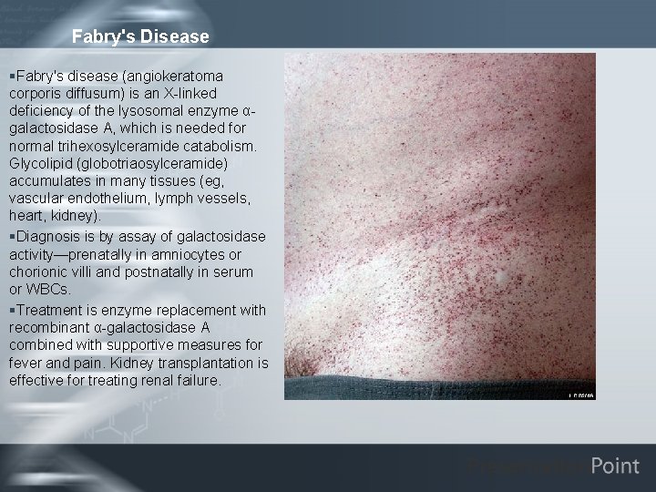 Fabry's Disease §Fabry's disease (angiokeratoma corporis diffusum) is an X-linked deficiency of the lysosomal