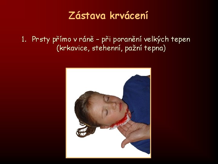 Zástava krvácení 1. Prsty přímo v ráně – při poranění velkých tepen (krkavice, stehenní,