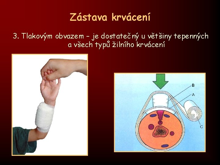 Zástava krvácení 3. Tlakovým obvazem – je dostatečný u většiny tepenných a všech typů