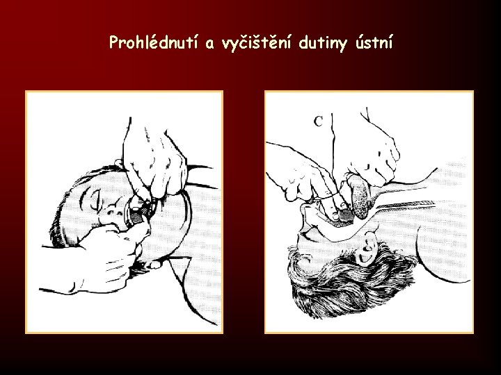 Prohlédnutí a vyčištění dutiny ústní 