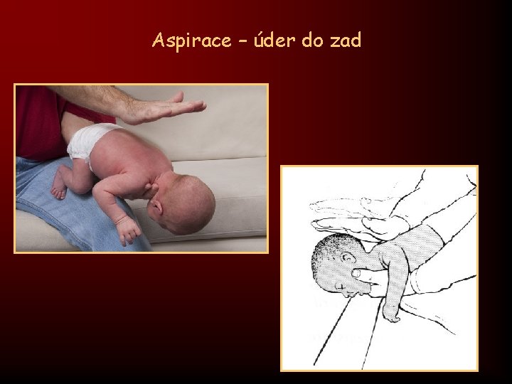 Aspirace – úder do zad 