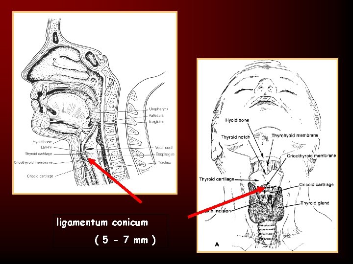 ligamentum conicum ( 5 - 7 mm ) 