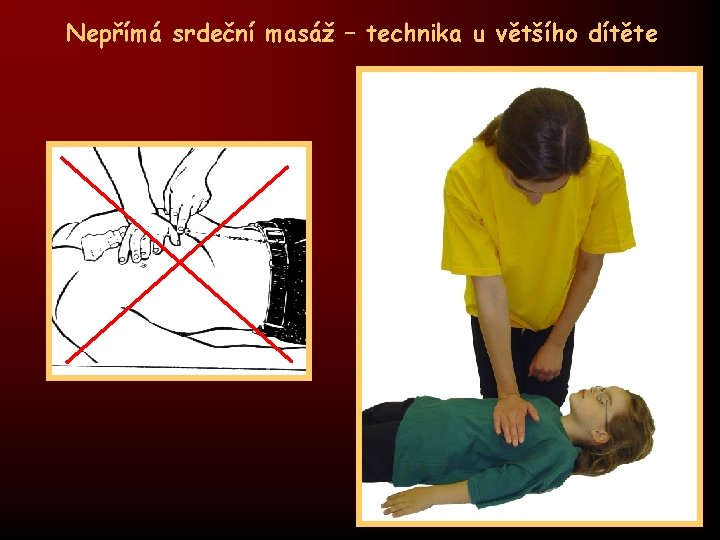 Nepřímá srdeční masáž – technika u většího dítěte 