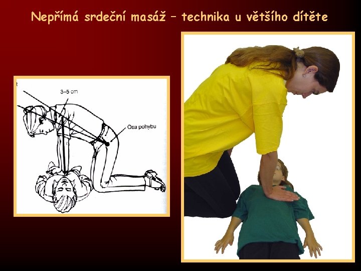 Nepřímá srdeční masáž – technika u většího dítěte 