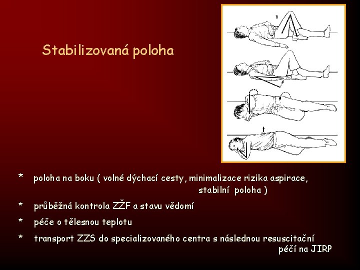 Stabilizovaná poloha * poloha na boku ( volné dýchací cesty, minimalizace rizika aspirace, stabilní