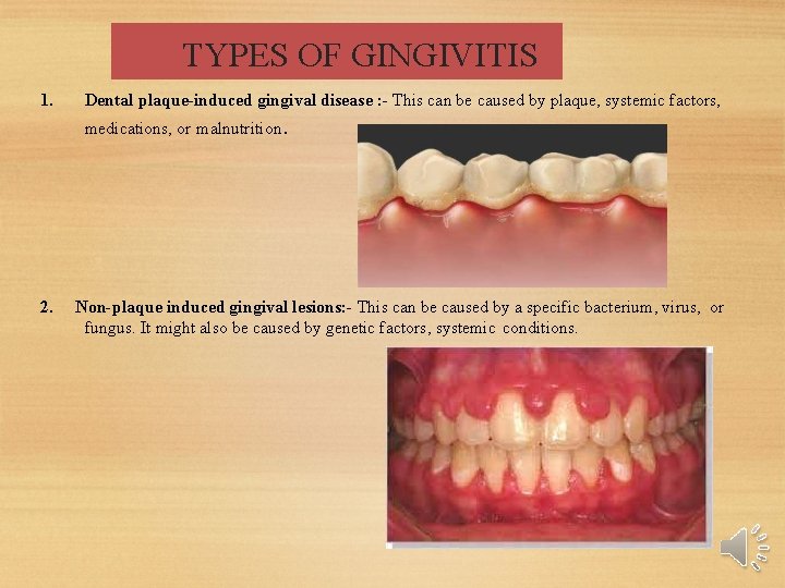 TYPES OF GINGIVITIS 1. Dental plaque-induced gingival disease : - This can be caused TYPES OF GINGIVITIS 1. Dental plaque-induced gingival disease : - This can be caused