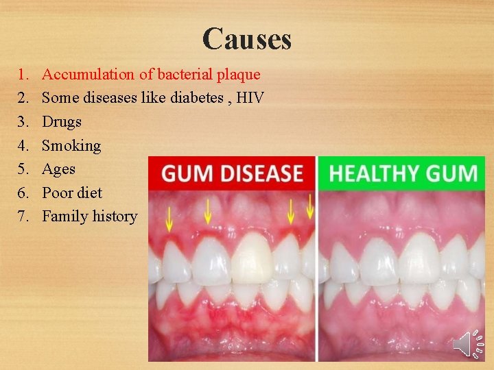 Causes 1. 2. 3. 4. 5. 6. 7. Accumulation of bacterial plaque Some diseases Causes 1. 2. 3. 4. 5. 6. 7. Accumulation of bacterial plaque Some diseases
