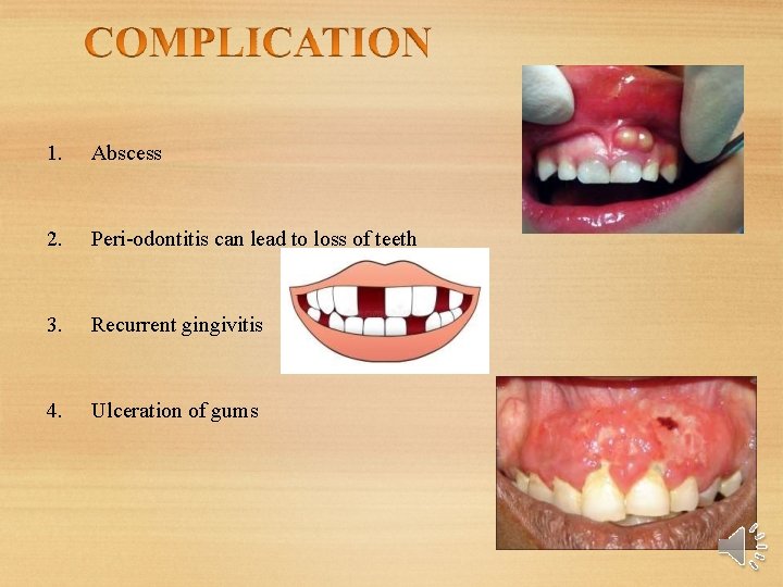 1. Abscess 2. Peri-odontitis can lead to loss of teeth 3. Recurrent gingivitis 4. 1. Abscess 2. Peri-odontitis can lead to loss of teeth 3. Recurrent gingivitis 4.