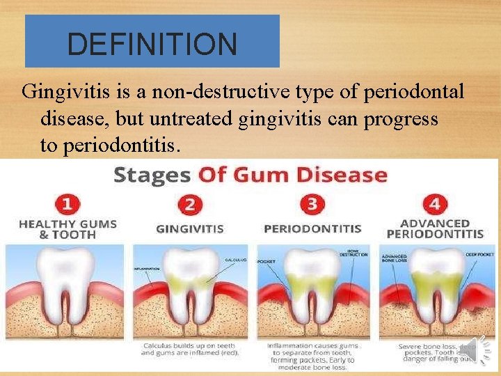 DEFINITION Gingivitis is a non-destructive type of periodontal disease, but untreated gingivitis can progress DEFINITION Gingivitis is a non-destructive type of periodontal disease, but untreated gingivitis can progress