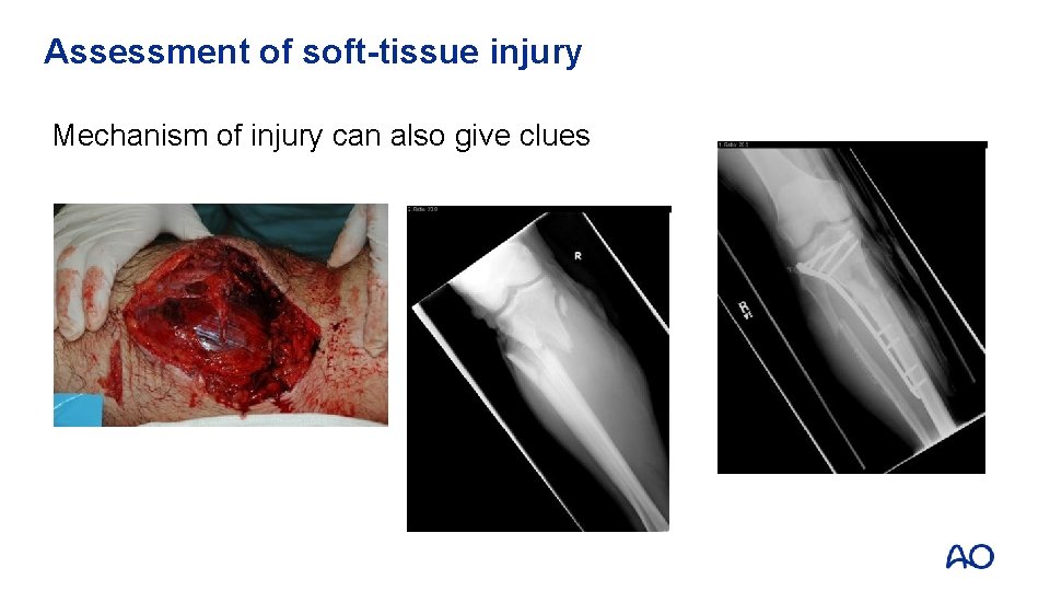 Assessment of soft-tissue injury Mechanism of injury can also give clues 