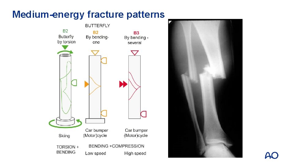Medium-energy fracture patterns B 2 