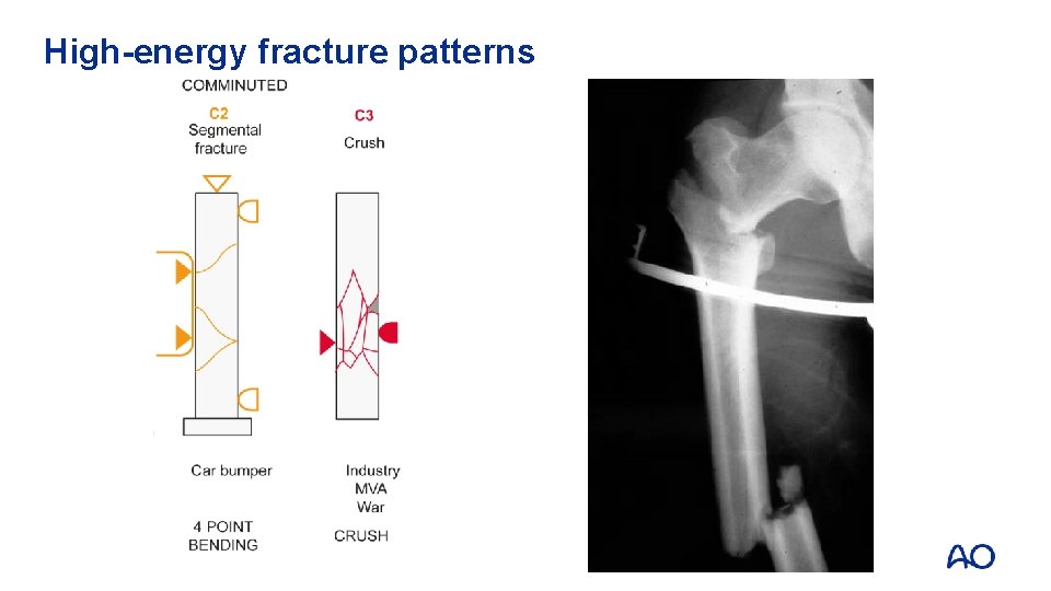 High-energy fracture patterns 