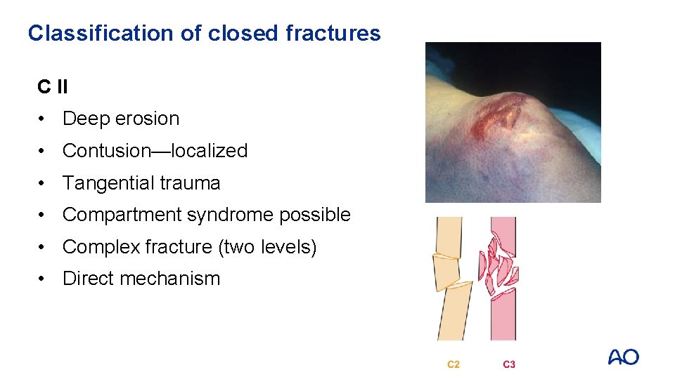 Classification of closed fractures C II • Deep erosion • Contusion—localized • Tangential trauma