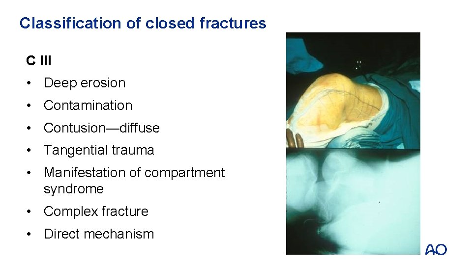 Classification of closed fractures C III • Deep erosion • Contamination • Contusion—diffuse •