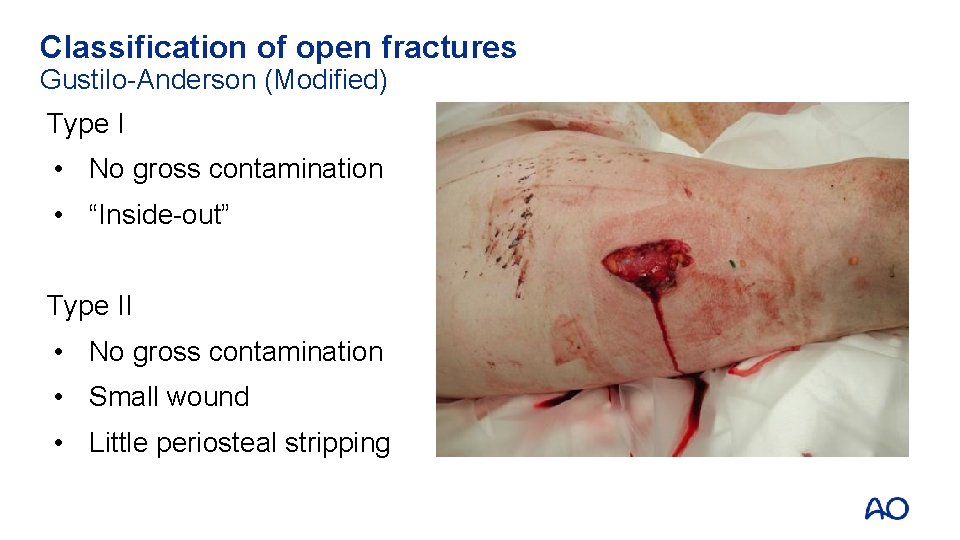 Classification of open fractures Gustilo-Anderson (Modified) Type I • No gross contamination • “Inside-out”