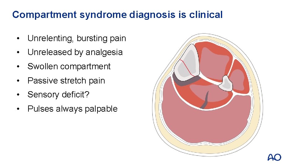 Compartment syndrome diagnosis is clinical • Unrelenting, bursting pain • Unreleased by analgesia •