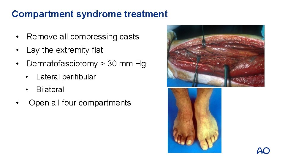 Compartment syndrome treatment • Remove all compressing casts • Lay the extremity flat •