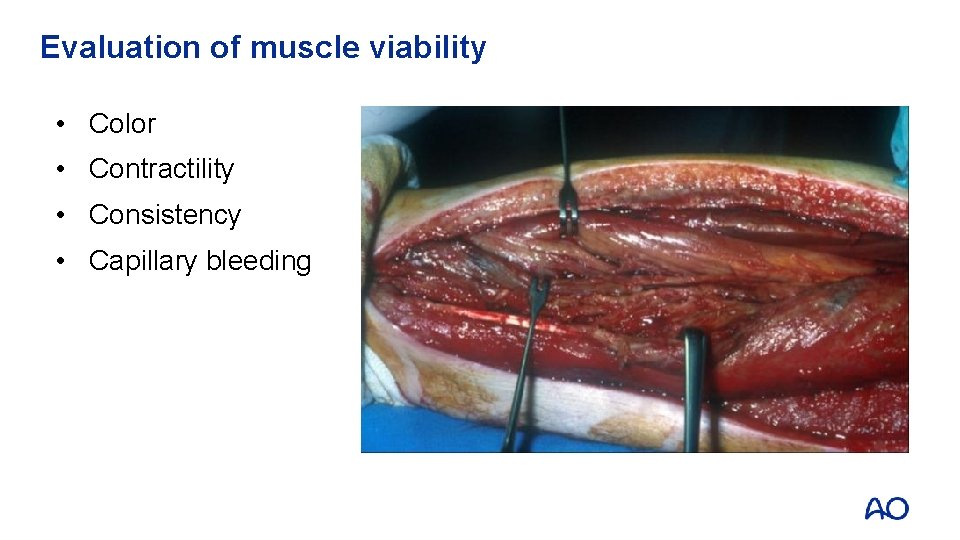 Evaluation of muscle viability • Color • Contractility • Consistency • Capillary bleeding 