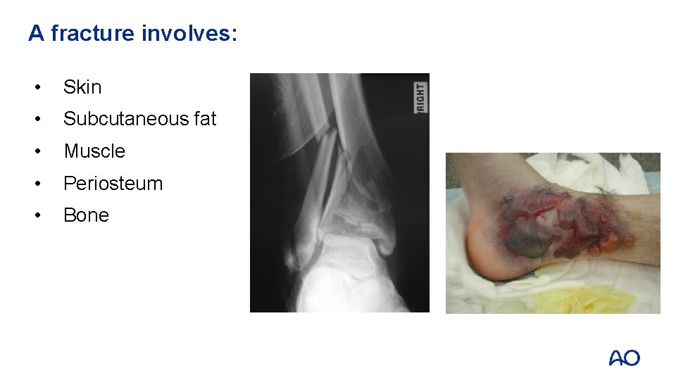 A fracture involves: • Skin • Subcutaneous fat • Muscle • Periosteum • Bone