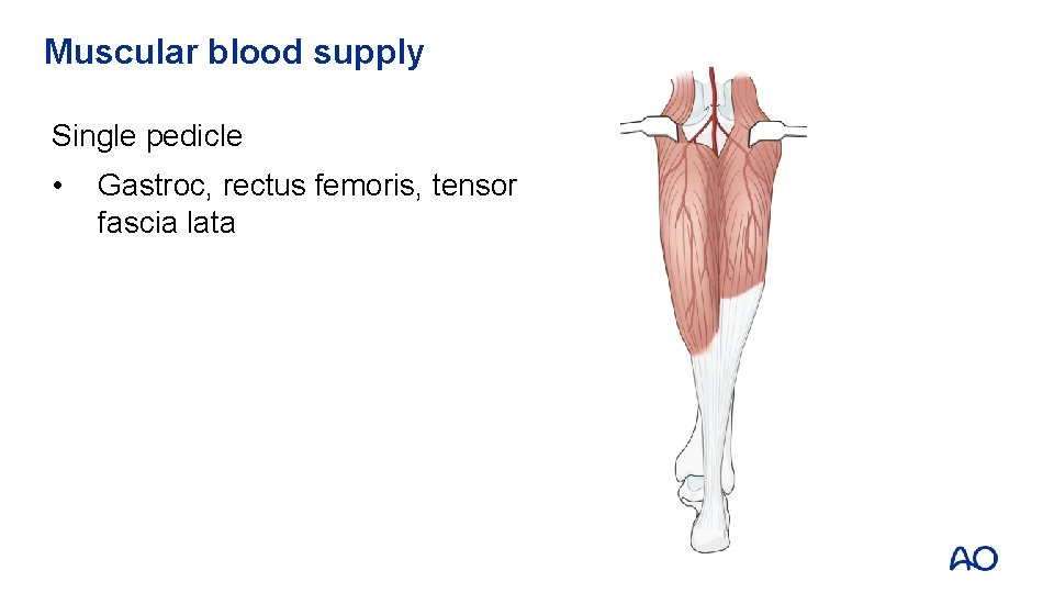 Muscular blood supply Single pedicle • Gastroc, rectus femoris, tensor fascia lata 