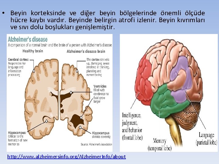  • Beyin korteksinde ve diğer beyin bölgelerinde önemli ölçüde hücre kaybı vardır. Beyinde