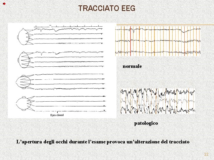 TRACCIATO EEG normale patologico L’apertura degli occhi durante l’esame provoca un’alterazione del tracciato 22