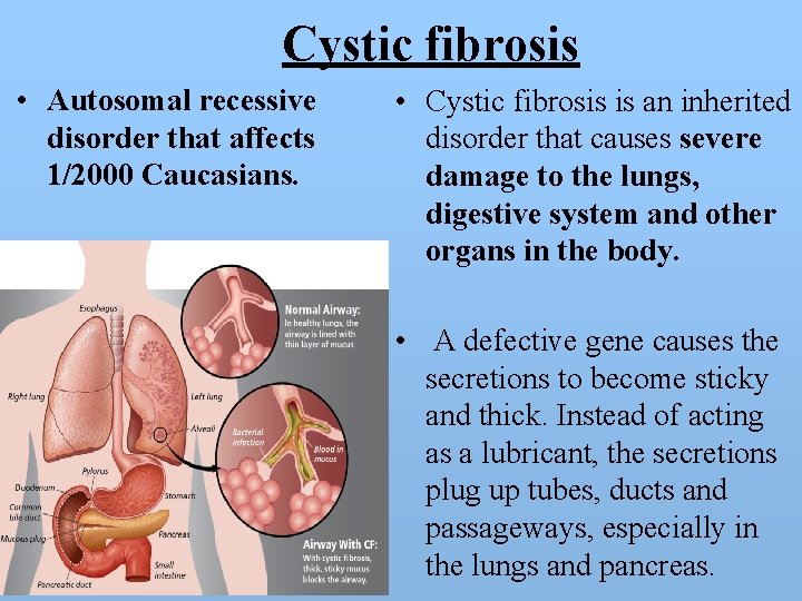 Cystic fibrosis • Autosomal recessive disorder that affects 1/2000 Caucasians. • Cystic fibrosis is