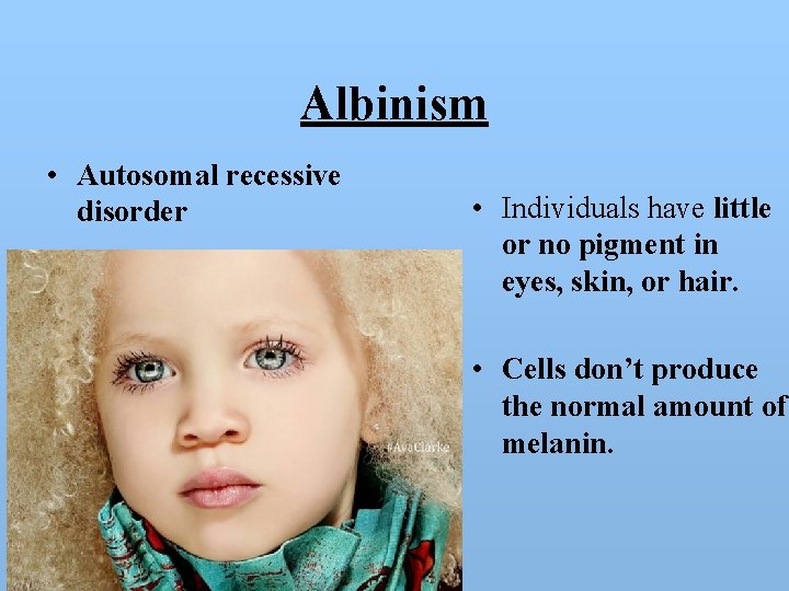 Albinism • Autosomal recessive disorder • Individuals have little or no pigment in eyes,