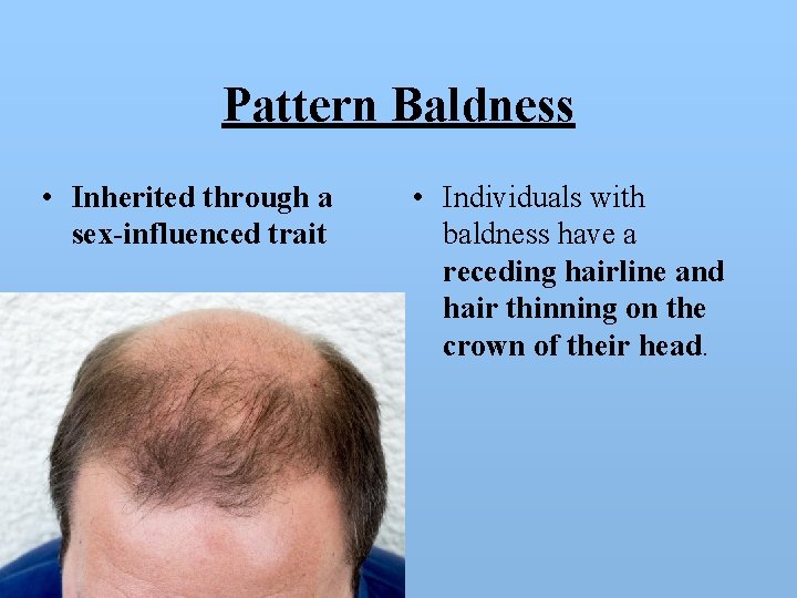 Pattern Baldness • Inherited through a sex-influenced trait • Individuals with baldness have a