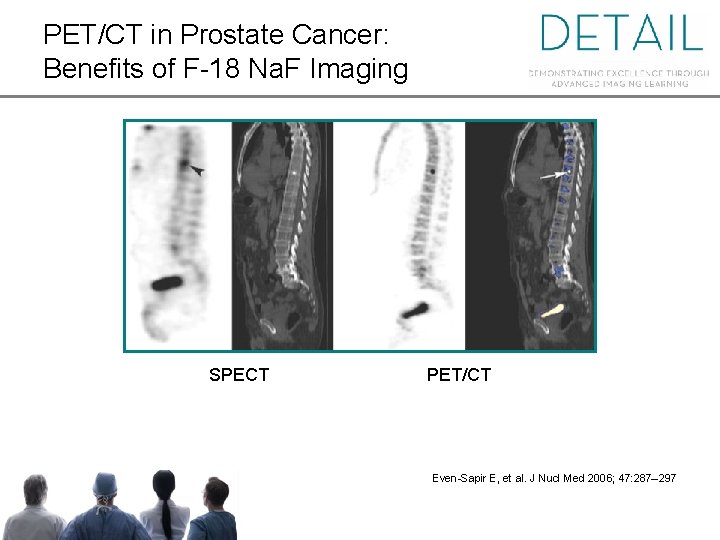 PET/CT in Prostate Cancer: Benefits of F-18 Na. F Imaging SPECT PET/CT Even-Sapir E,