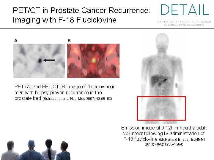 PET/CT in Prostate Cancer Recurrence: Imaging with F-18 Fluciclovine PET (A) and PET/CT (B)
