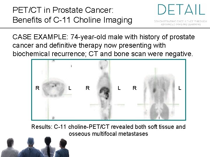 PET/CT in Prostate Cancer: Benefits of C-11 Choline Imaging CASE EXAMPLE: 74 -year-old male