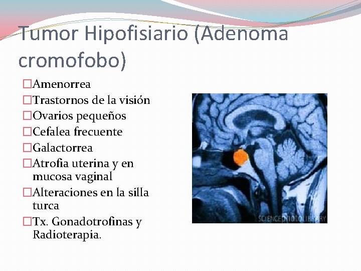 Tumor Hipofisiario (Adenoma cromofobo) �Amenorrea �Trastornos de la visión �Ovarios pequeños �Cefalea frecuente �Galactorrea Tumor Hipofisiario (Adenoma cromofobo) �Amenorrea �Trastornos de la visión �Ovarios pequeños �Cefalea frecuente �Galactorrea