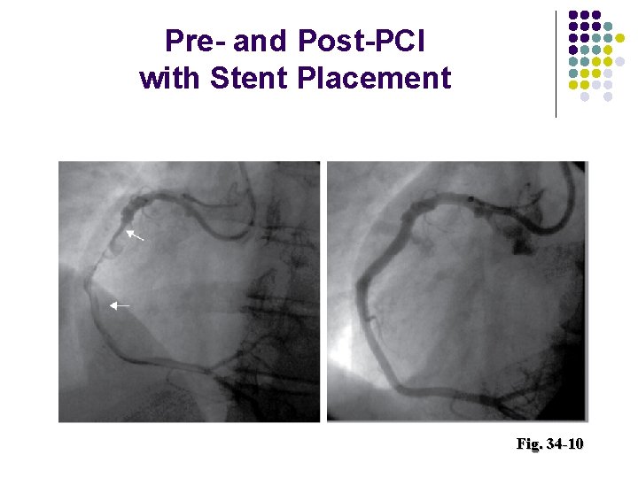 Pre- and Post-PCI with Stent Placement Fig. 34 -10 