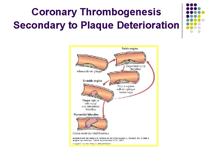Coronary Thrombogenesis Secondary to Plaque Deterioration 