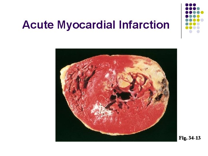 Acute Myocardial Infarction Fig. 34 -13  Acute Myocardial Infarction Fig. 34 -13