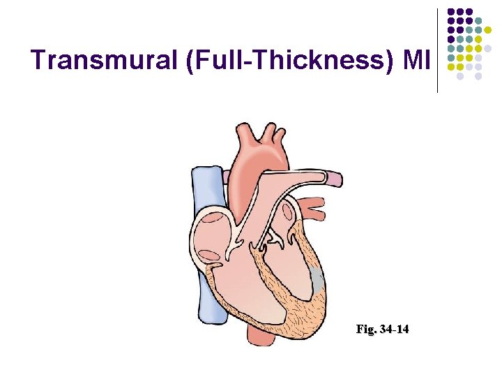 Transmural (Full-Thickness) MI Fig. 34 -14 