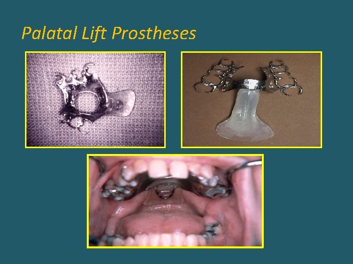 Palatal Lift Prostheses 