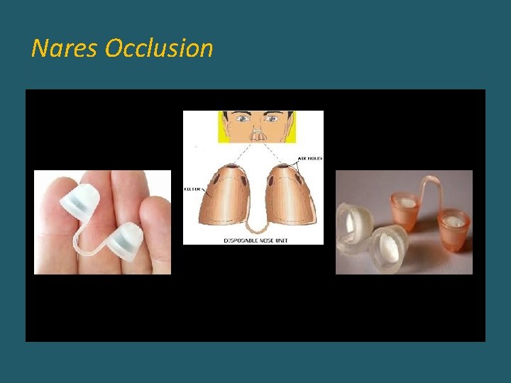 Nares Occlusion 