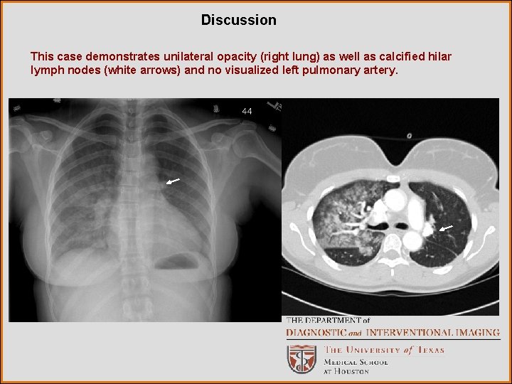 Discussion This case demonstrates unilateral opacity (right lung) as well as calcified hilar lymph