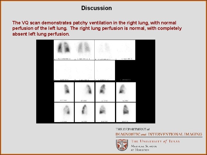 Discussion The VQ scan demonstrates patchy ventilation in the right lung, with normal perfusion