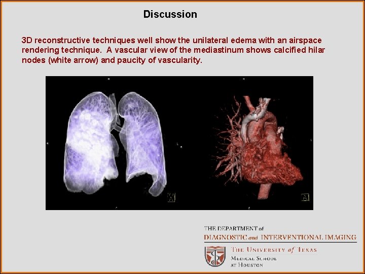 Discussion 3 D reconstructive techniques well show the unilateral edema with an airspace rendering