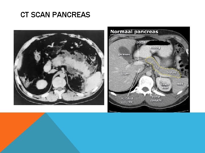 CT SCAN PANCREAS 