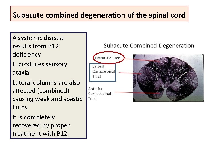 Subacute combined degeneration of the spinal cord A systemic disease results from B 12